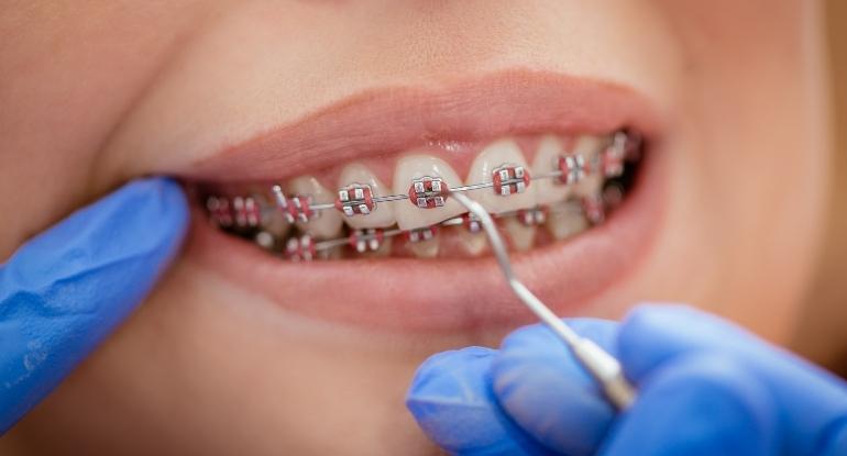 Braces Treatment